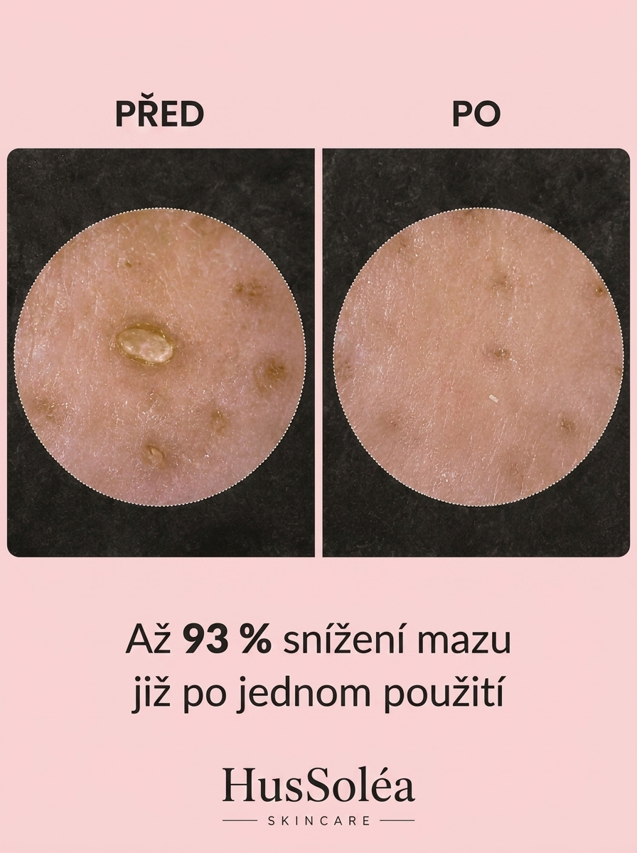 HusSoléa Peel Shot – Sérum z černé rýže proti pórům a mastné pleti